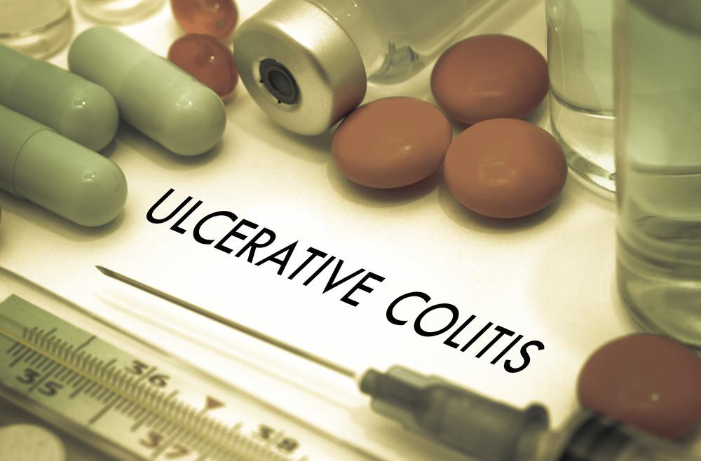 An overview for the treatment of Ulcerative Colitis