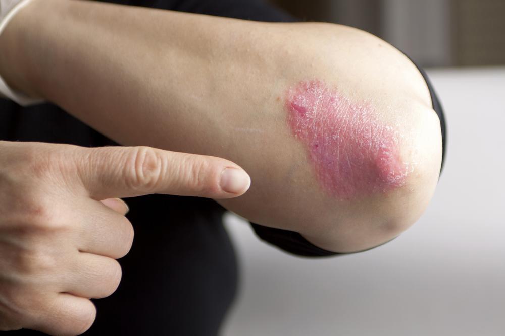 Psoriasis Symptoms