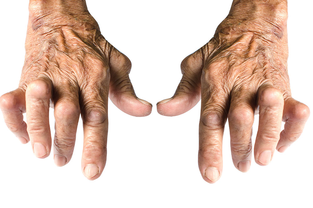 7 things to avoid to manage rheumatoid arthritis