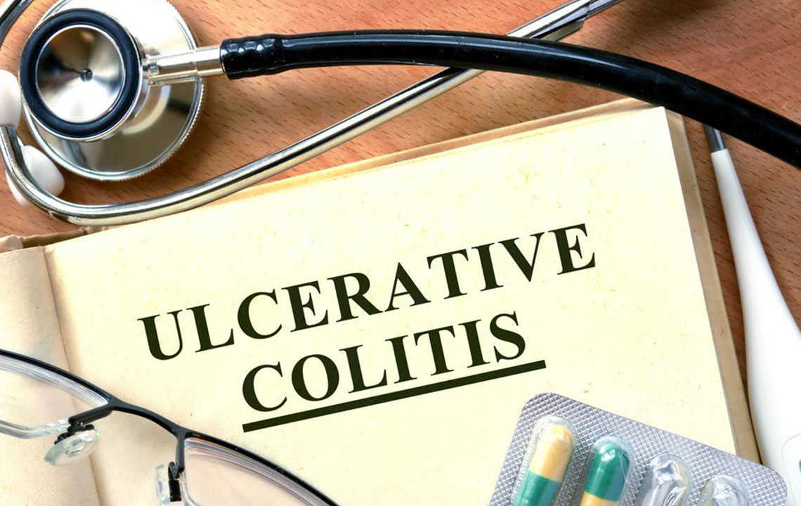 Beating Ulcerative Colitis Flares