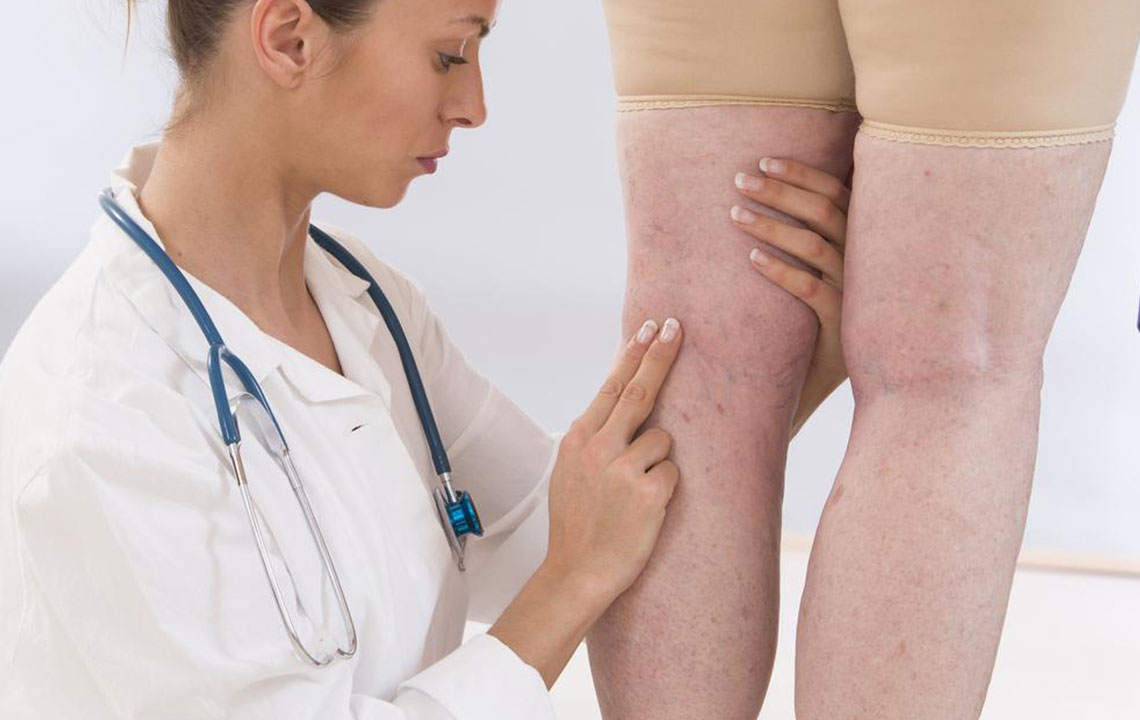 Effective Treatment for Varicose Veins