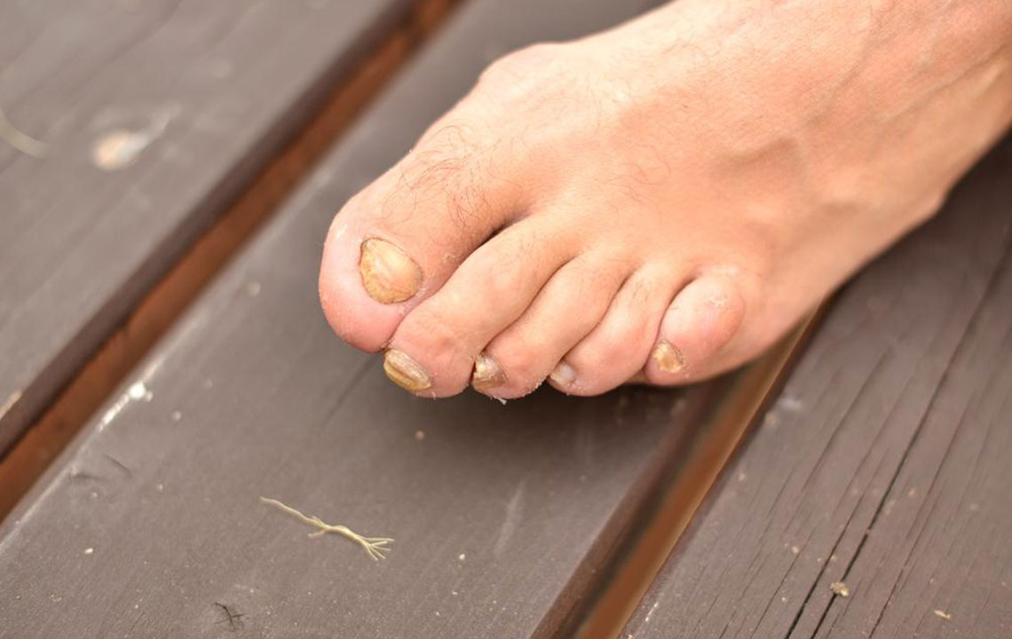 Most Beneficial Home Remedies for Toenail Fungus