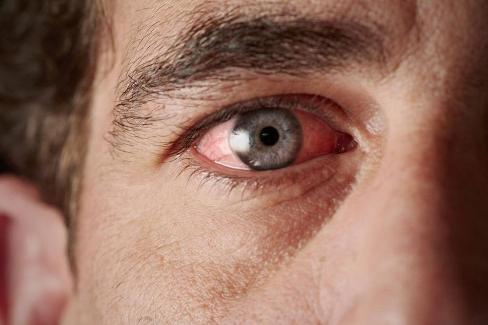 Sjogren’s Syndrome- Causes and Symptoms