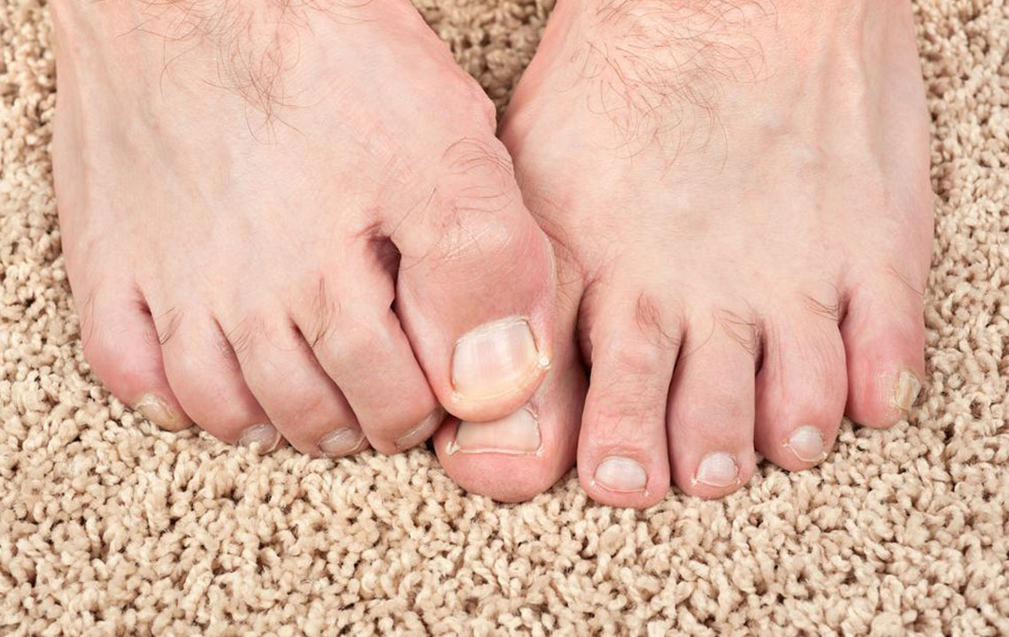 Some Effective Home Remedies for Toenail Fungus