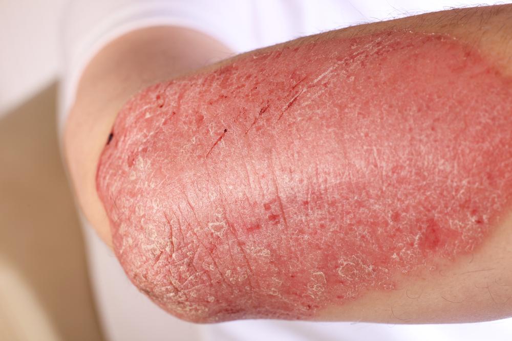 Symptoms, Causes, Types And Treament Of Eczema