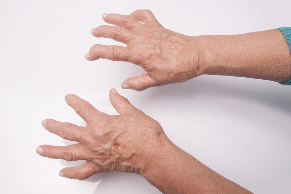 The Most Common Rheumatoid Arthritis Treatments