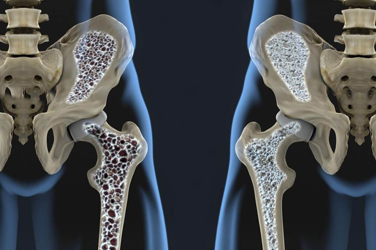 These Common Medical Conditions are Causing Your Osteoporosis Bone Loss