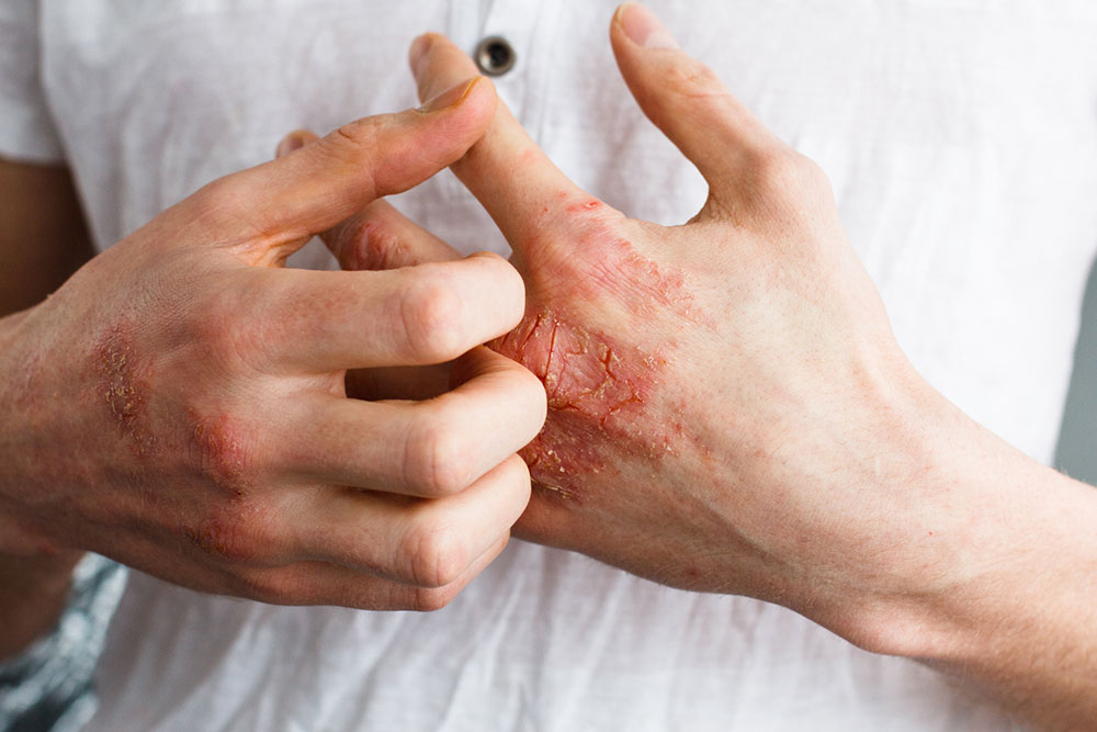 Things You Need to Know about Eczema